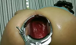 სპეკულუმის პროლაფსი  ...
